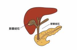 20岁女孩胆囊里取出近100颗石头 只因从小爱吃这些…